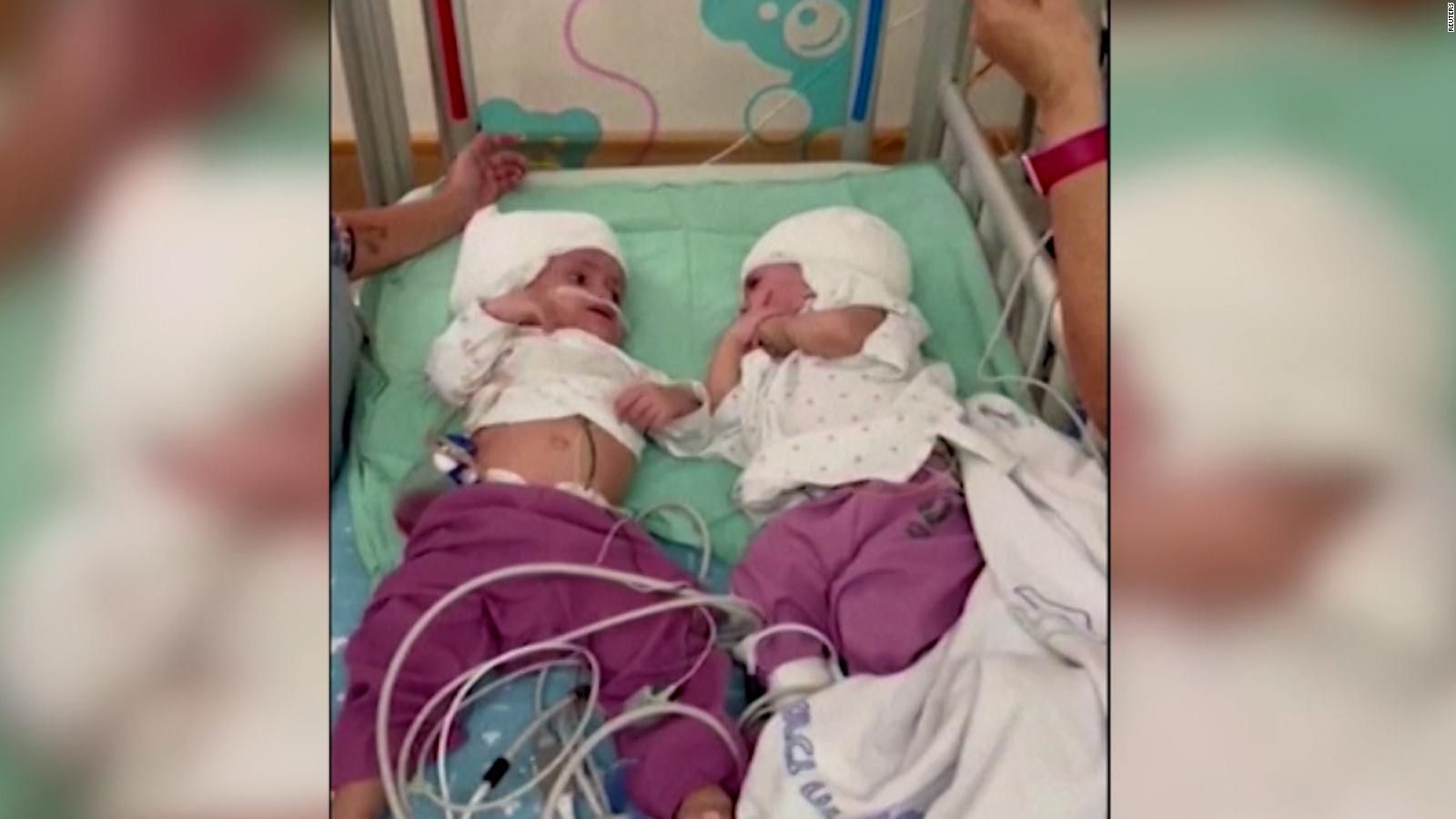 Separan a dos gemelas unidas por la cabeza tras una operación de 12 horas en Israel