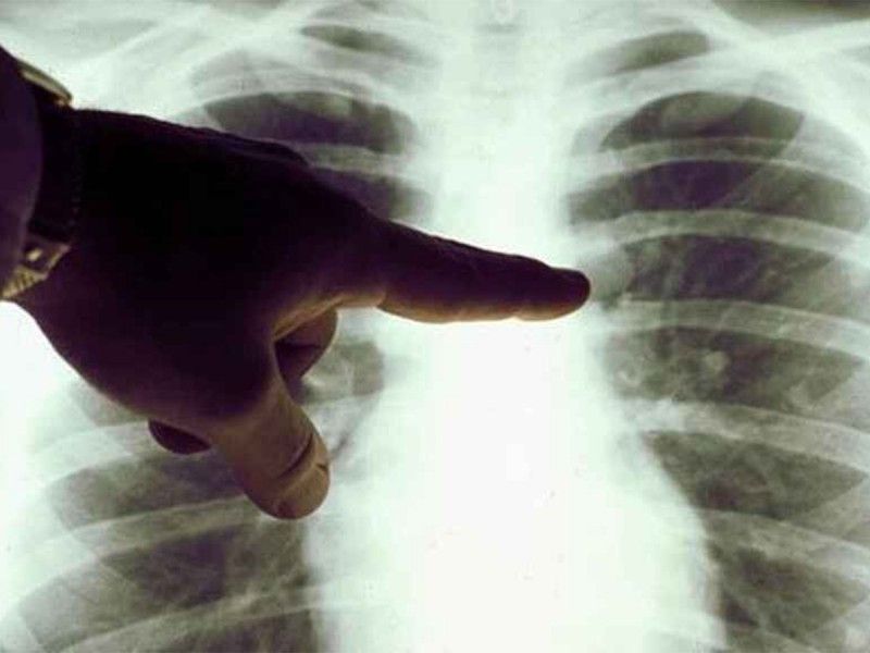 Muerte temprana; alertan de cáncer pulmón