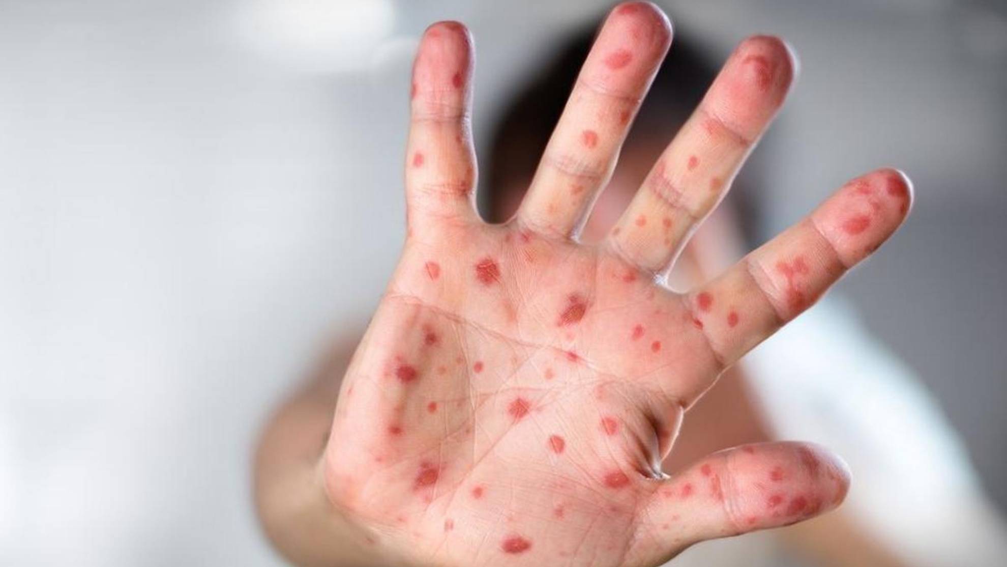 OMS renombrará viruela del mono para evitar estigmas o connotaciones racistas