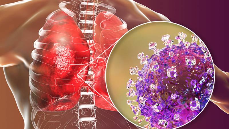 Henipavirus: ¿Qué tanto debe preocuparnos el nuevo virus detectado en China?