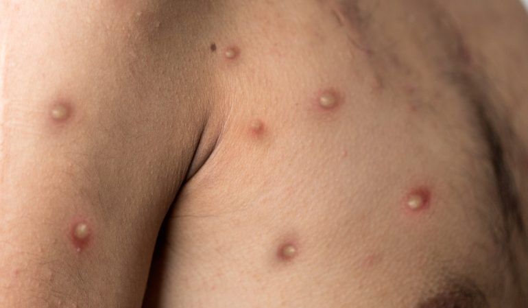 EL TRÁGICO RELATO DE UN JOVEN CON VIRUELA DEL MONO: “ME DEPRIMÍ BASTANTE, NO SABÍA QUÉ HACER”