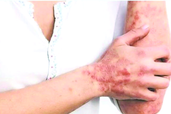 Emiten alerta por viruela del mono