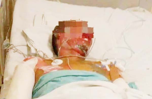 Muere a causa de quemaduras