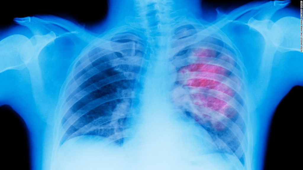 Casi la mitad de las muertes por cáncer en todo el mundo se deben a factores de riesgo prevenibles, sugiere un nuevo estudio