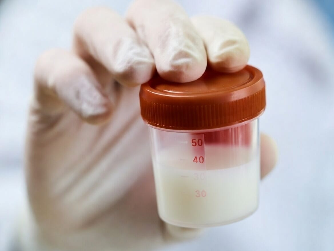 DETECTAN POR PRIMERA VEZ TRANSMISIÓN DE ENFERMEDAD GENÉTICA A TRAVÉS DE DONACIÓN DE ESPERMA