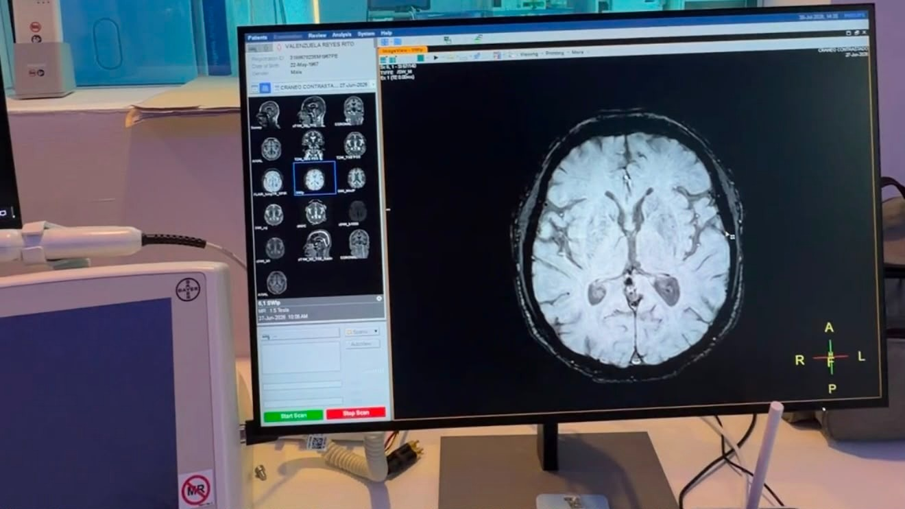 IMSS COAHUILA FORTALECE ATENCIÓN DE EMBOLIAS CEREBRALES CON EL CÓDIGO CEREBRO